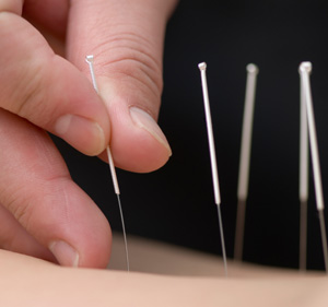 Galway acupuncture